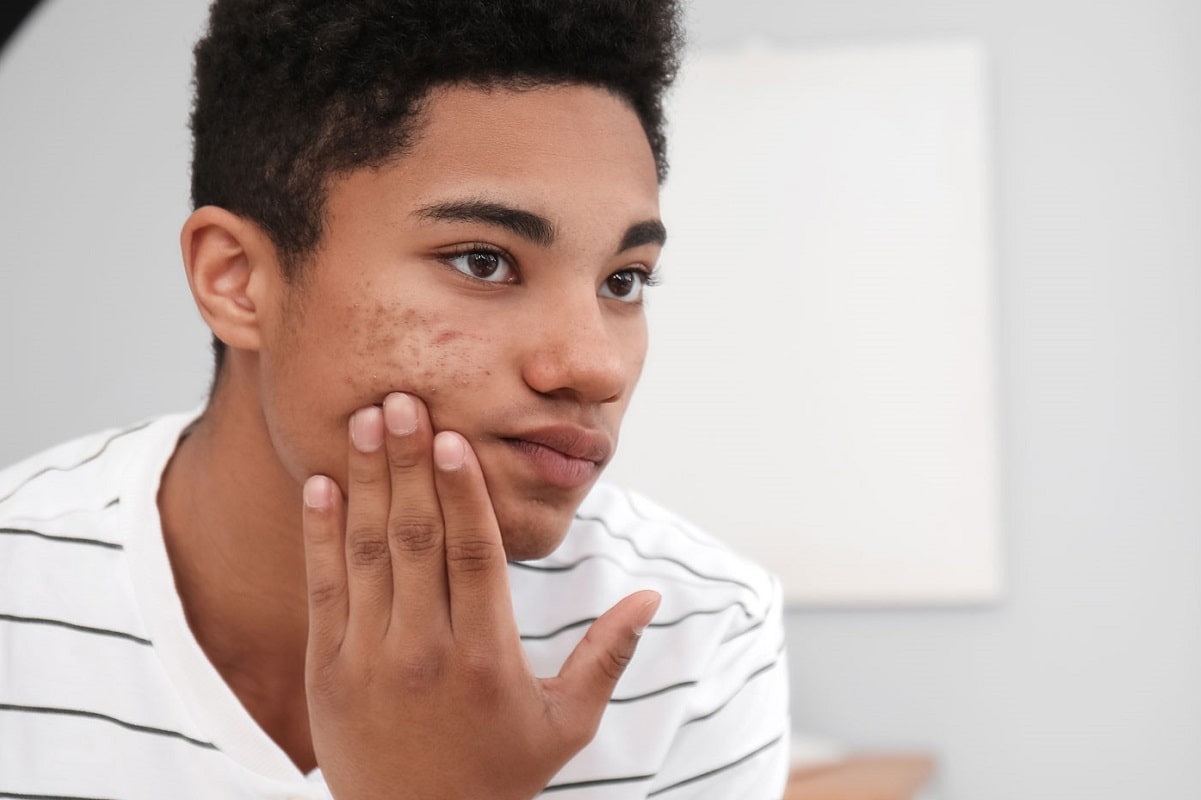 Teen Acne and Epiduo Gel: What You Need to Know Teen Acne and Epiduo Gel: What You Need to Know